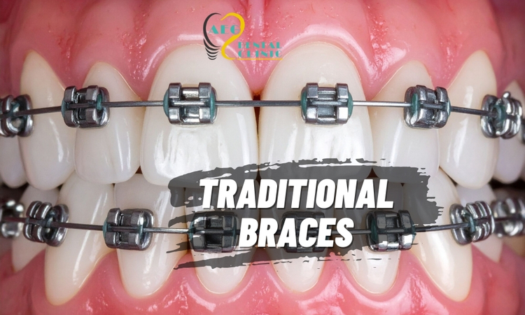 Proven Strength: Metal and Ceramic Braces