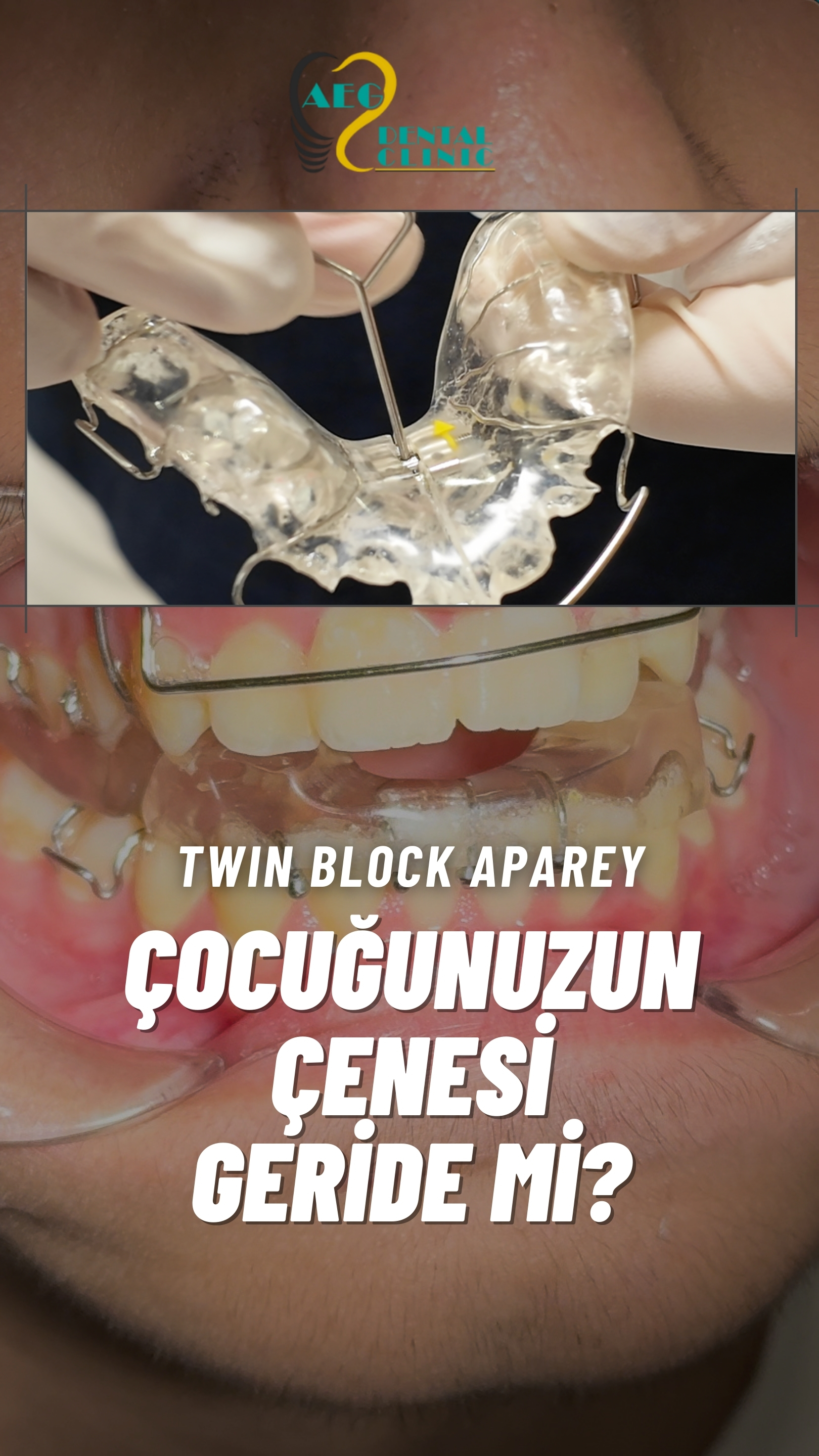 Çocuklarda Çene Geriliği nasıl tedavi edilir?