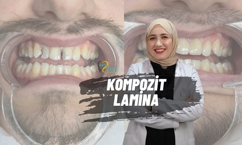 9 Dişlik Estetik Dokunuş: Adım Adım Mükemmel Gülüş Tasarımı